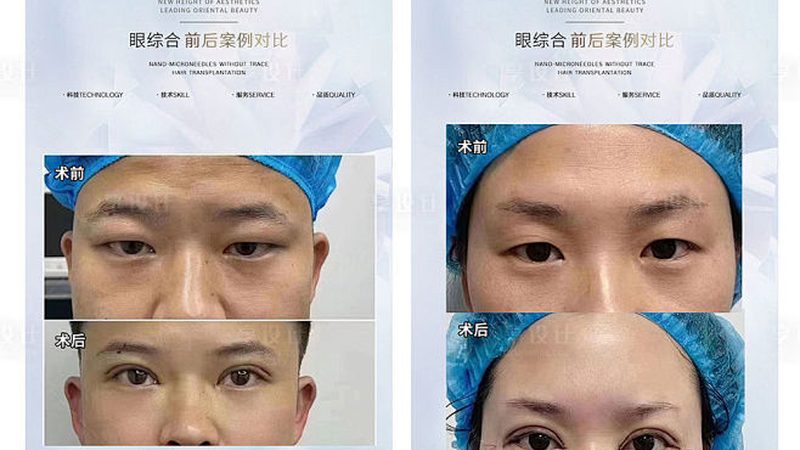 光子嫩肤全脸价格揭秘：了解真相，理性消费