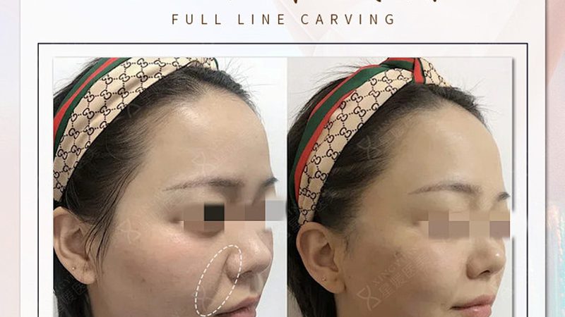 揭秘成都小型激光脱毛机：技术原理与选购要点
