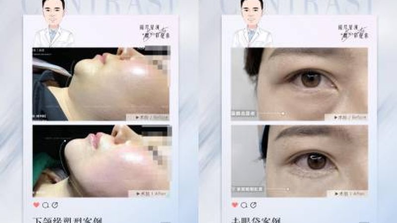 局麻双眼皮手术，揭秘手术步骤与注意事项**