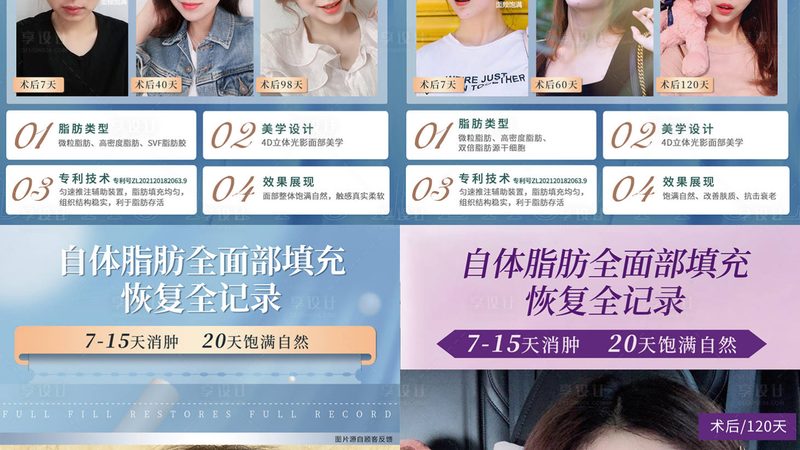 上海隆鼻医生硅胶和膨体怎么选