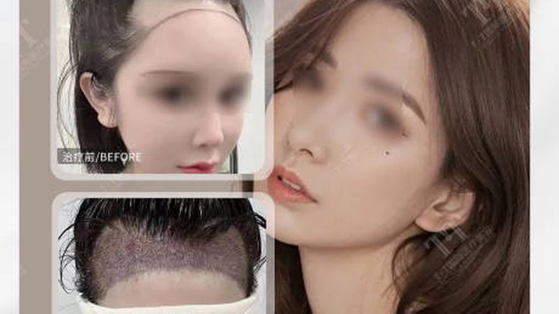 假体隆鼻歪斜？揭秘修复背后的秘密