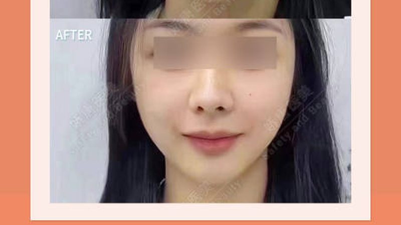 小标题：超声炮术后饮食建议