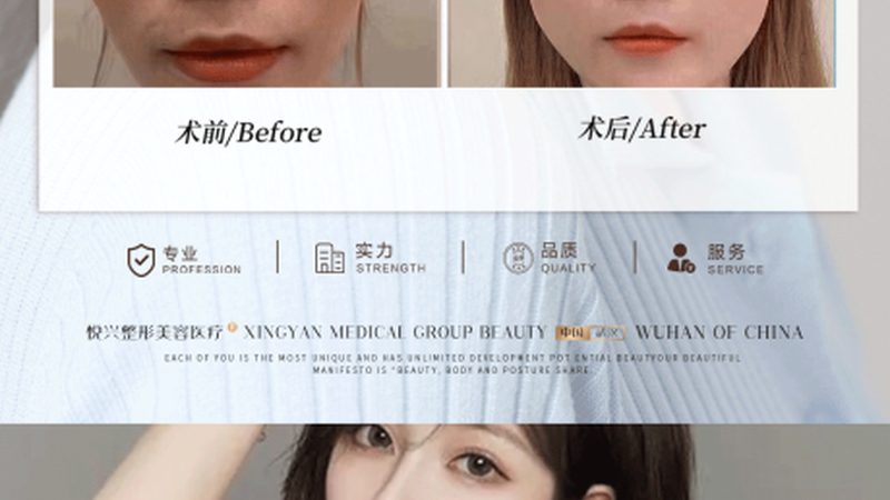 家用激光祛斑仪器哪个牌子有效