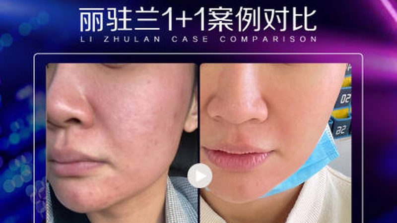 广州二氧化碳激光祛斑机：揭秘其工作原理与选购要点**