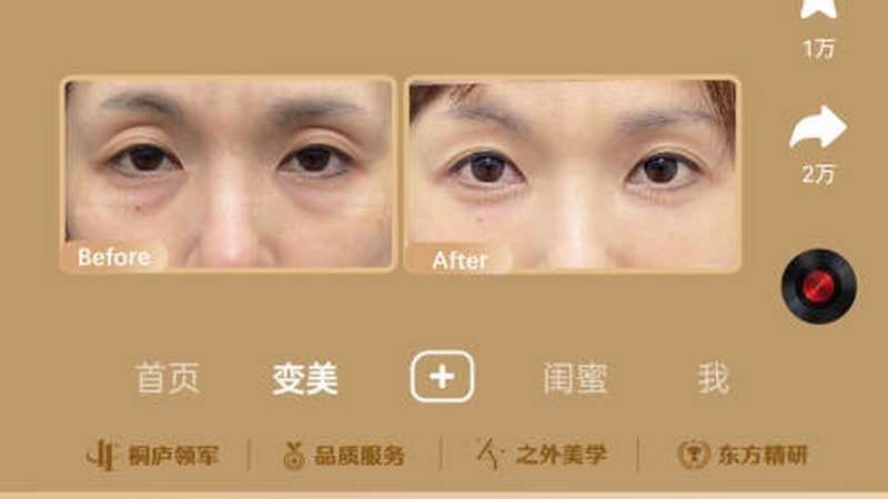 双眼皮贴松弛？揭秘双眼皮成型与修复之道