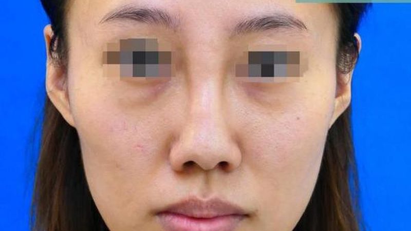 光子嫩肤与水光针联合治疗：揭秘美白护肤新趋势